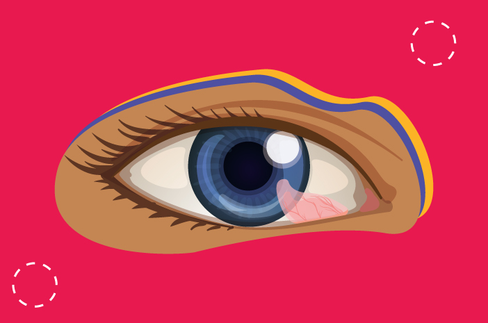 Оболочка глаза разрастается из-за птеригиума.