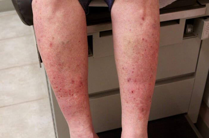 피부에 영향을 미치는 자가면역질환인 포진성 피부염 알아보기