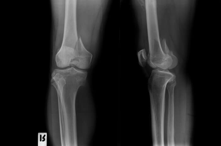 Attention, les fractures naturelles peuvent provoquer de l'arthrose