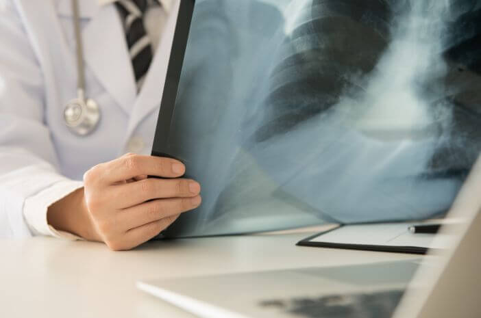 5 datos sobre las radiografías de pulmón que necesita saber