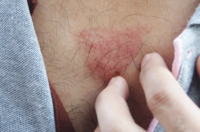Vorsicht, Pityriasis Rosea verursacht Hautausschläge so groß wie Münzen und Schuppen