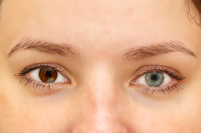 Peut-on guérir le trouble oculaire d'hétérochromie?