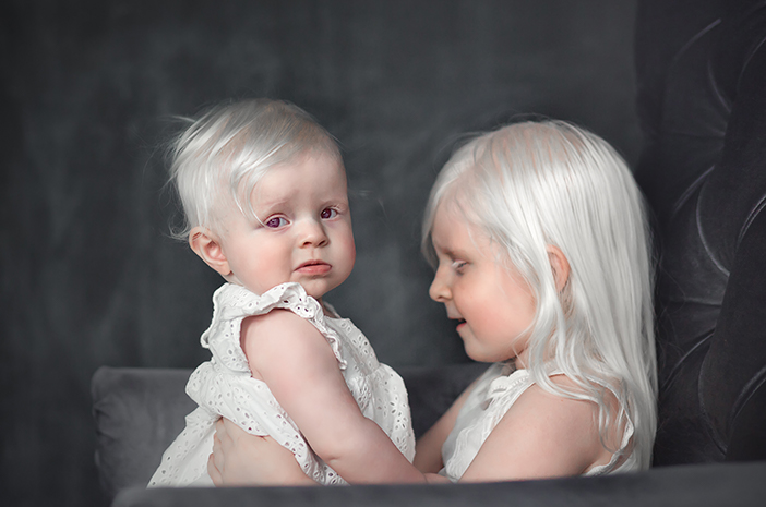 Pacienții de albinos pot avea probleme cu ochii, iată o explicație