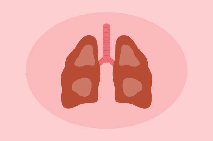 Bloed hoesten, waarschuwingssymptomen van bronchiëctasie