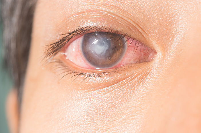 6 formas de limpiar las lentes de contacto para prevenir las úlceras corneales