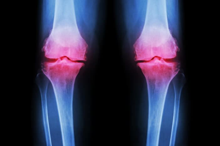 Pourquoi les femmes sont-elles plus à risque d'arthrose ?
