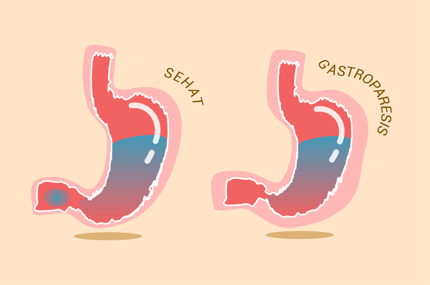 4 symptômes courants ressentis par les personnes atteintes de gastroparésie