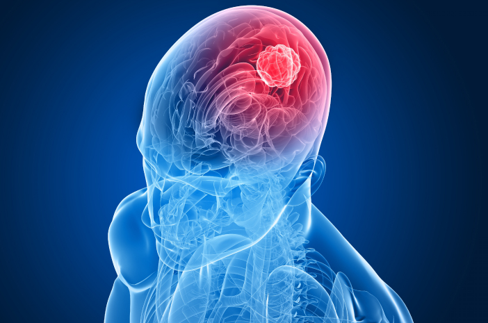 Cómo prevenir los tumores cerebrales que necesita saber