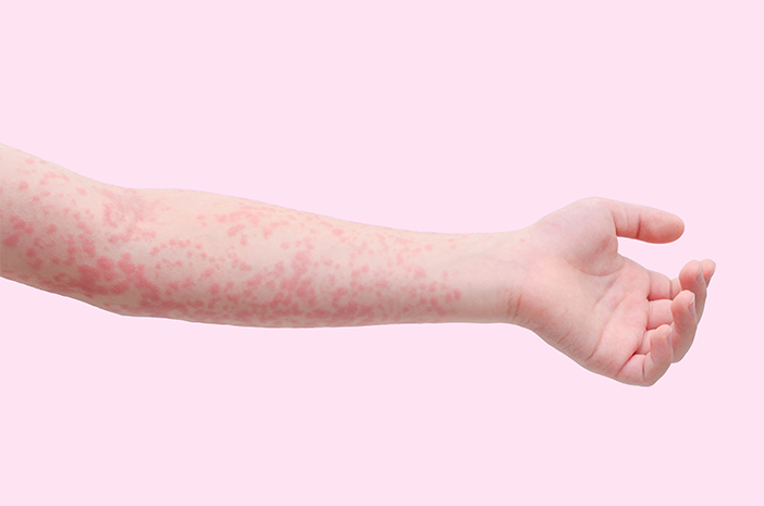 Кропив’янка, алергія чи біль на шкірі?