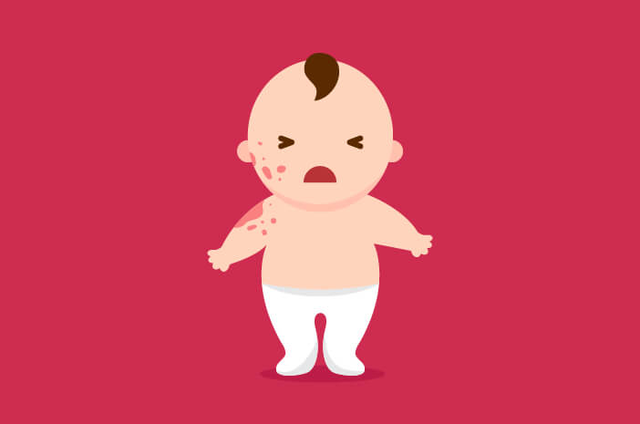 4 tipp anyáknak, ha a baba atópiás dermatitisben szenved