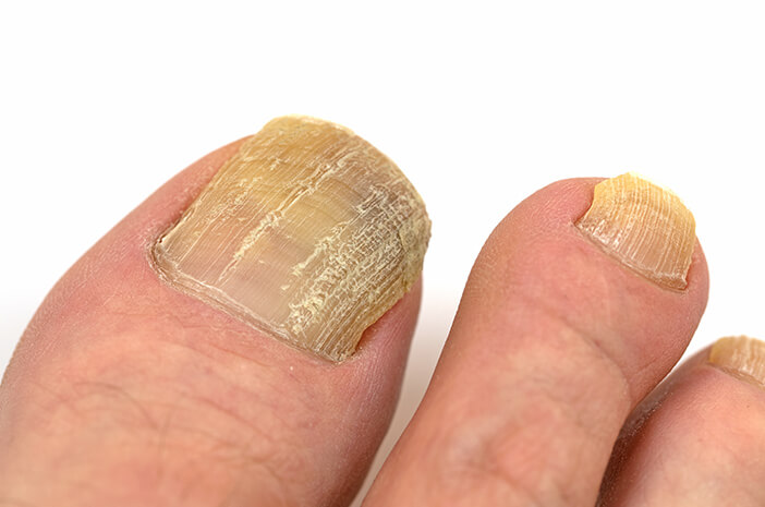 Łuszczyca Idap zwiększa ryzyko grzybicy paznokci