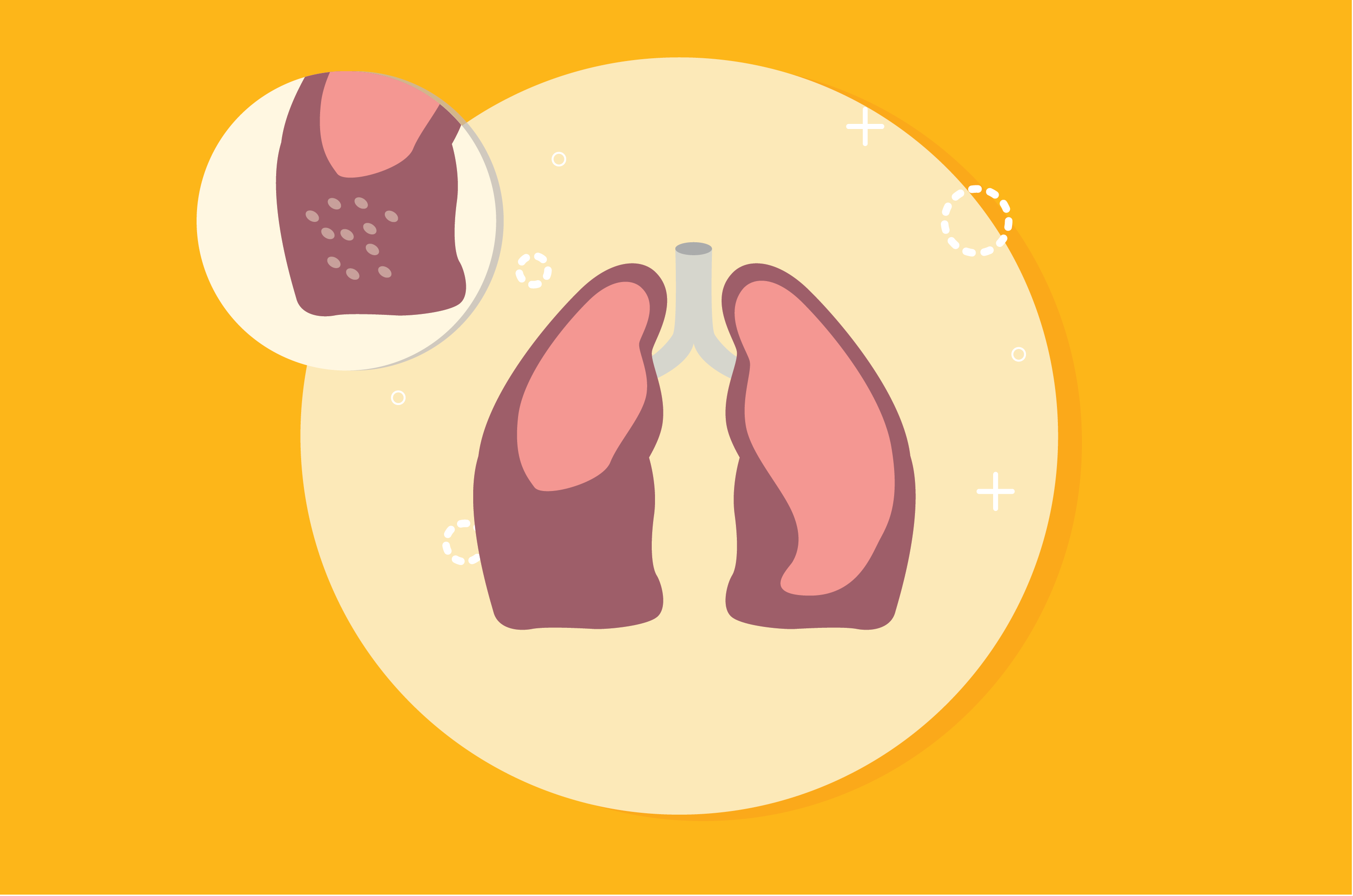 Накопичення рідини в легенях може викликати плевральний випіт