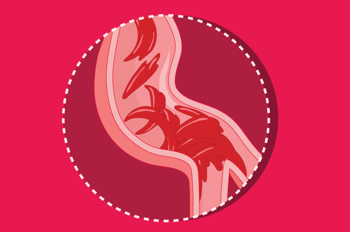 5 фактов о серповидной анемии