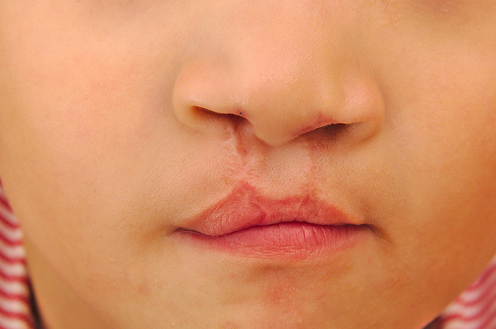 5 Ursachen für Babys, die mit Lippenspalten geboren wurden